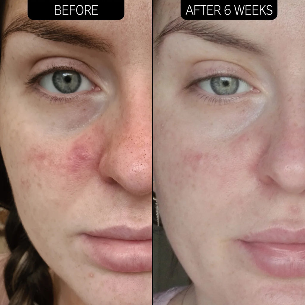 Azelaic Acid Serum 10% - MazenOnline