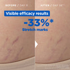 Mixa - Anti Stretch Mark Oil - For Skin with Stretch Marks - With Omega 6 & 9 | MazenOnline