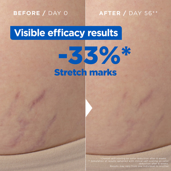 Mixa - Anti Stretch Mark Oil - For Skin with Stretch Marks - With Omega 6 & 9 | MazenOnline